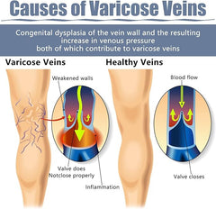 Hyggear Varicose Veins Spray - Natural Relief Treatment for Legs, Spider Varicose Vein and Strengthen Capillary Health
